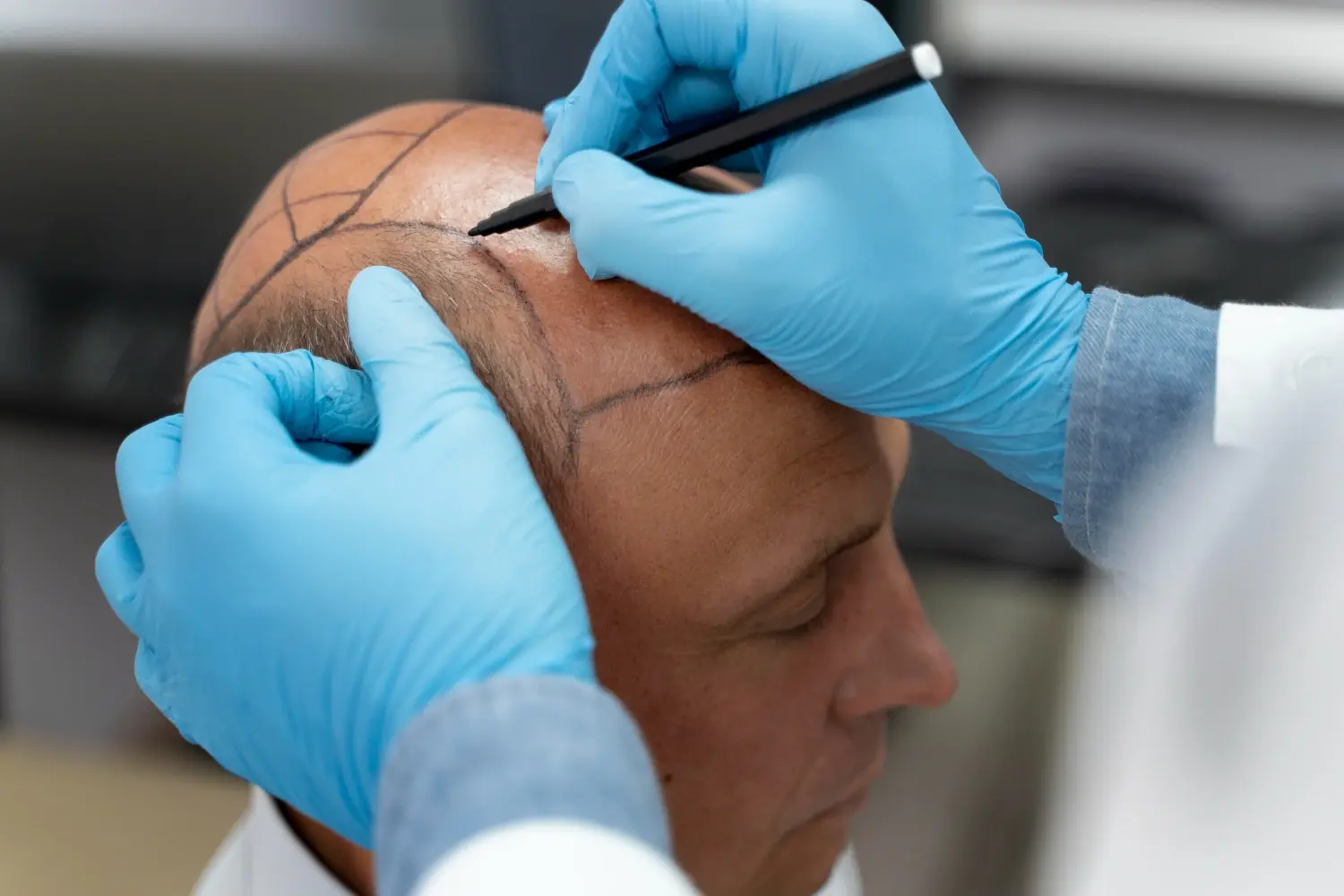 15 Hair Transplant Mistakes to Avoid Before & After Surgery